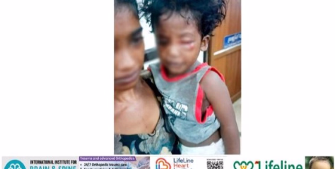 മൂ​ന്നു വ​യ​സ്സു​കാ​രി​ക്ക്​ തെ​രു​വു​നാ​യു​ടെ​ ക്രൂ​ര​മാ​യ ആ​ക്ര​മ​ണം